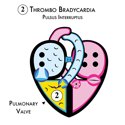 Thrombo Bradycardia