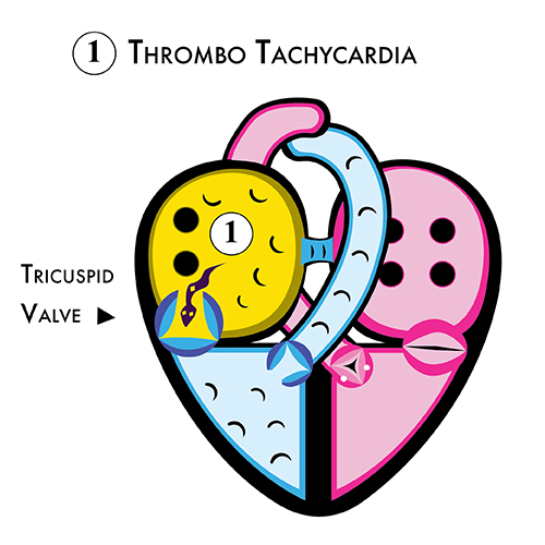 Thrombo Tachycardia